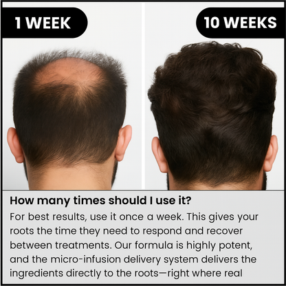 Hair Regrowth System - Scalp Stamping Ritual